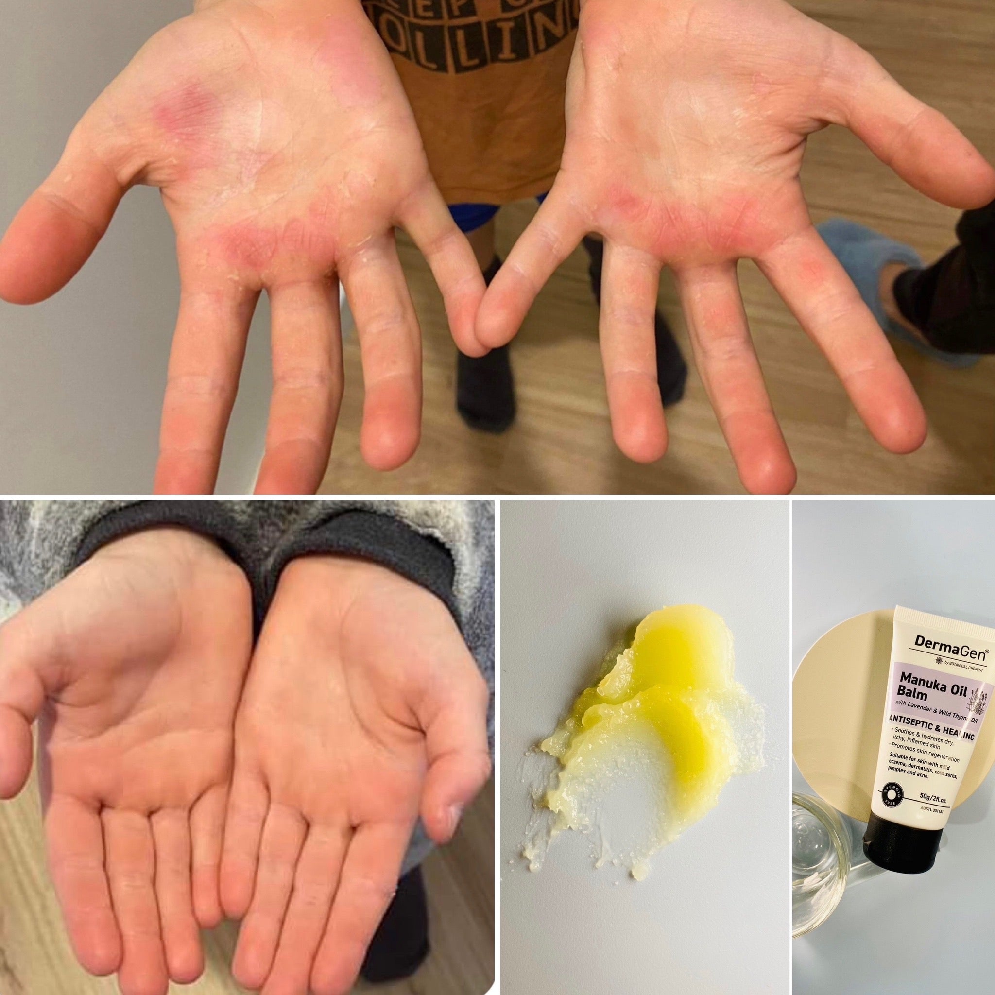 DermaGen Manuka Balm - Your