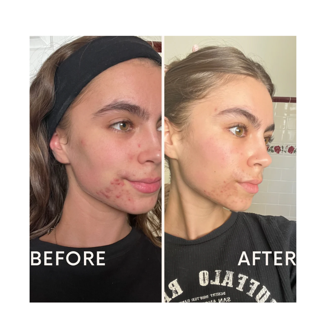 Teen ClearSkin Propolis Pro Acne Care Kit
