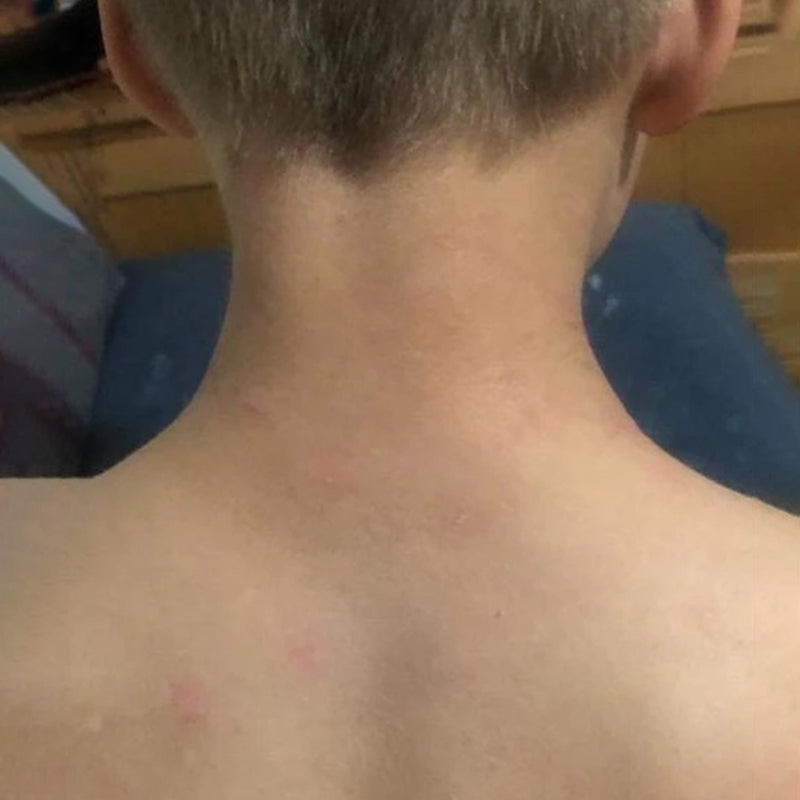 Topical Steroid Withdrawal after treatment