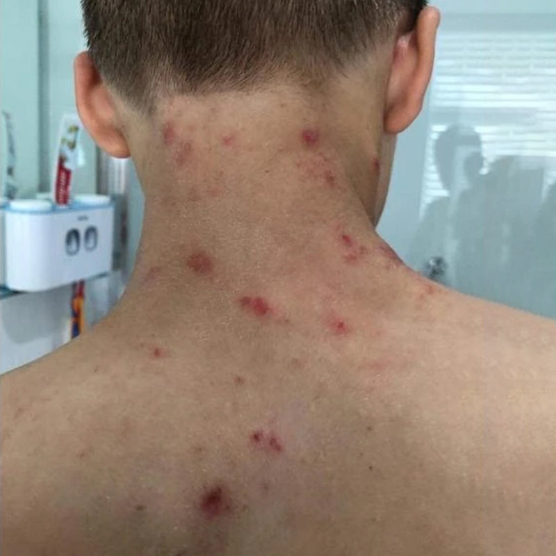 Topical Steroid Withdrawal before treatment