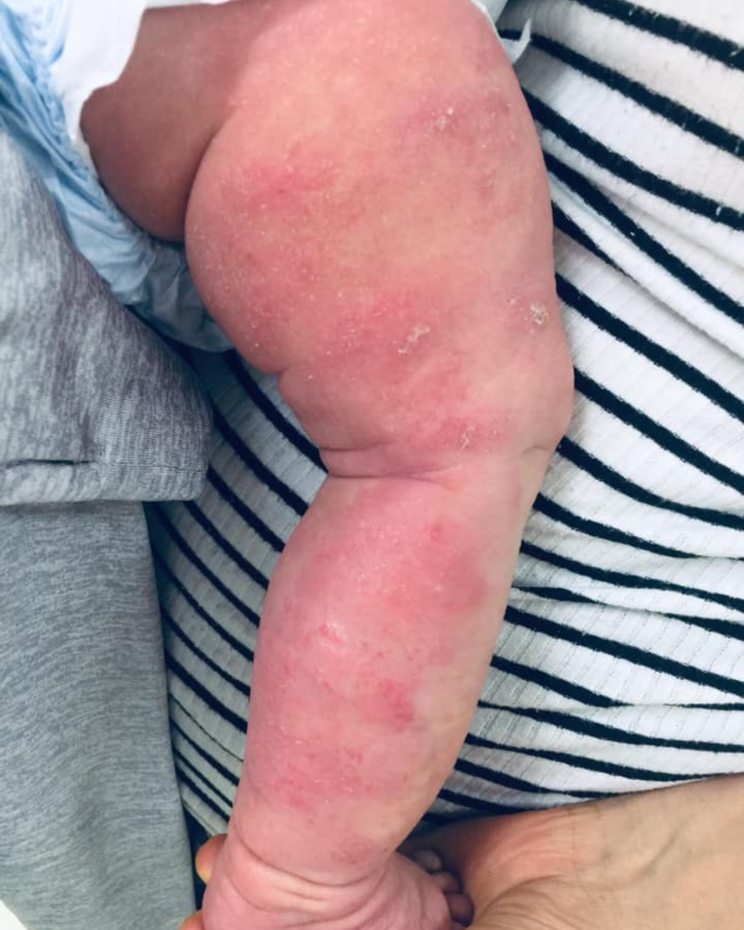 baby eczema before treatment