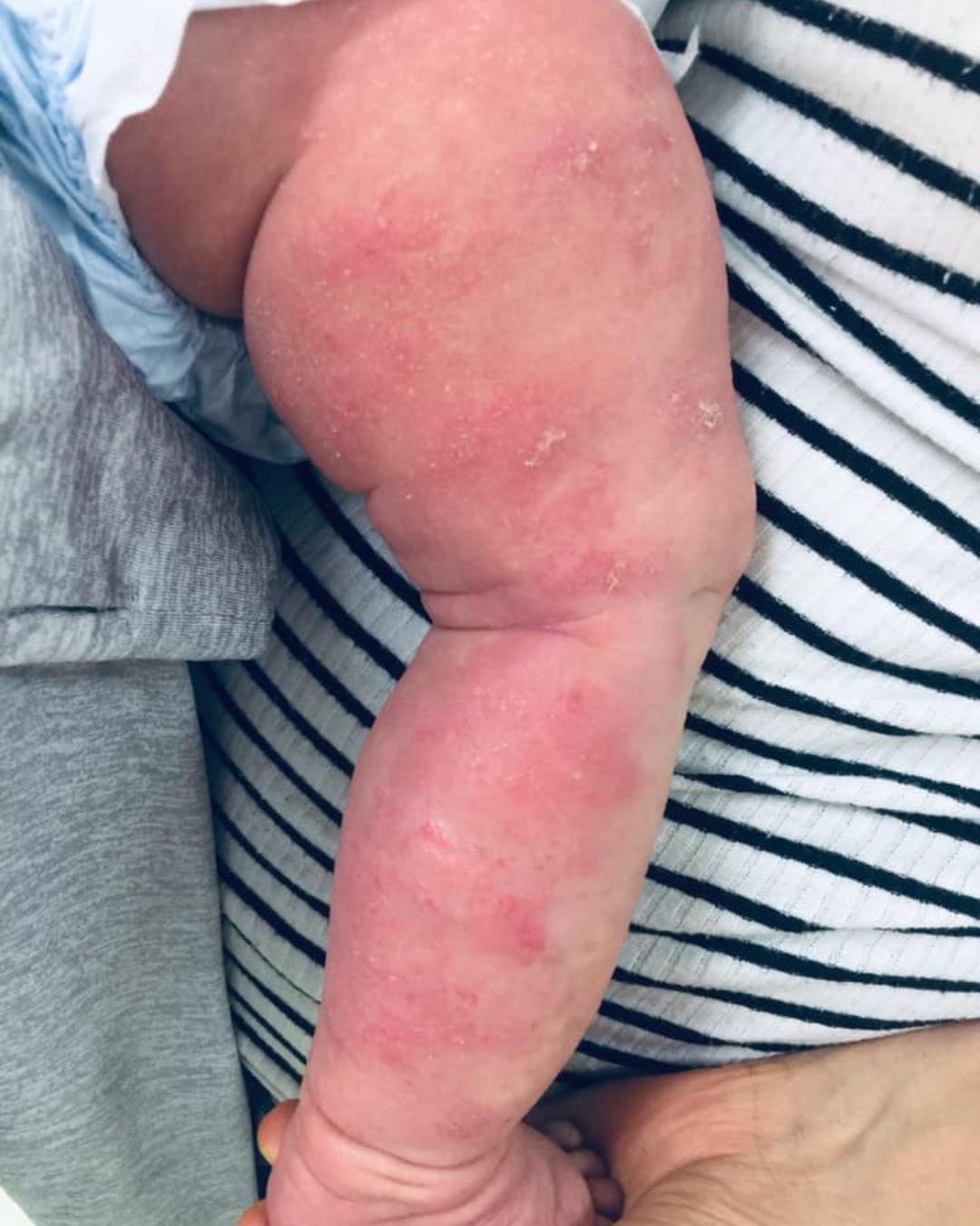 baby eczema before treatment 