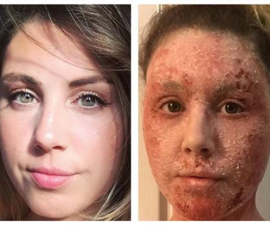 topical steroid withdrawal symptoms