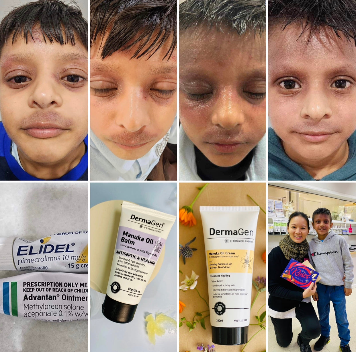 Topical Steroid Withdrawal What You Need To Know DermaGen By topical-steroid-withdrawal-what-you-need-to-know-dermagen-by