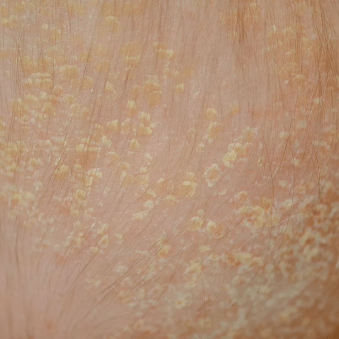 SEBORHEIC DERMATITIS