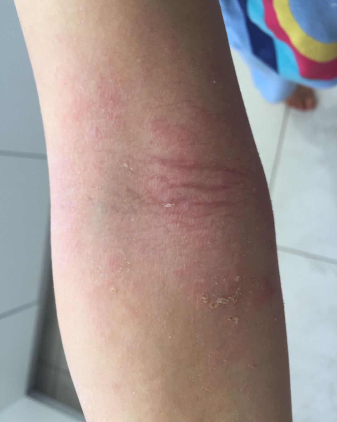 eczema flair up on arm after treatment 