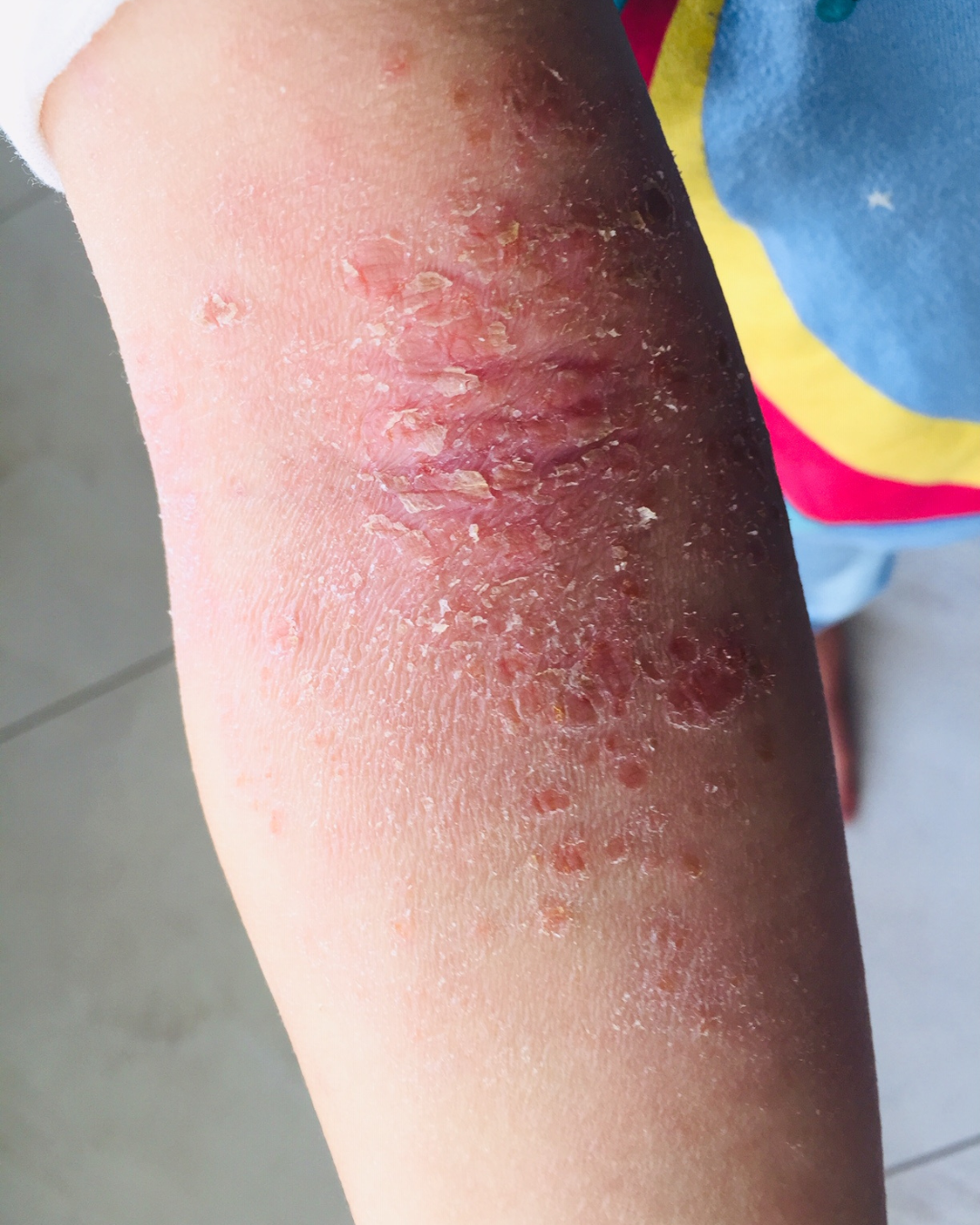 eczema flair up on arm before treatment