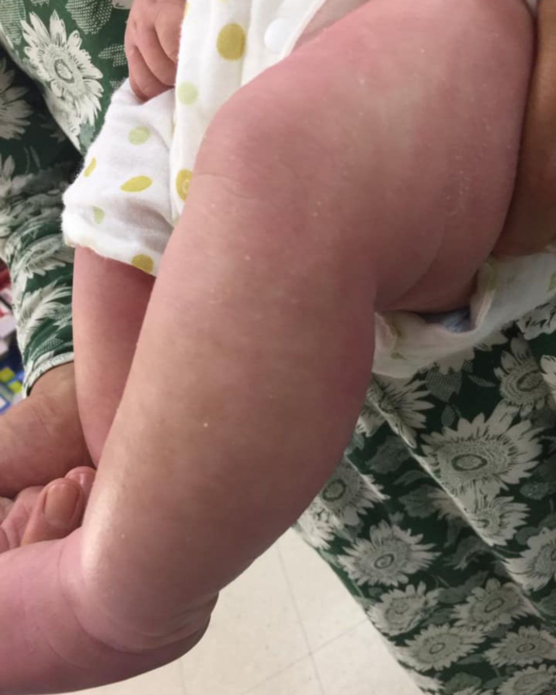 baby eczema after treatment 