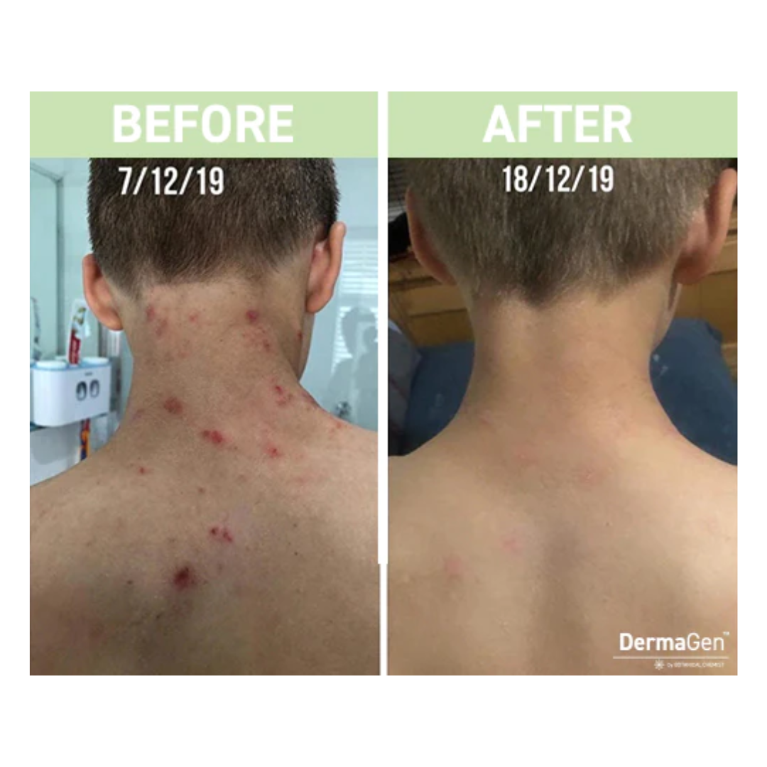 Topical Steroid Withdrawal What You Need To Know DermaGen By topical-steroid-withdrawal-what-you-need-to-know-dermagen-by