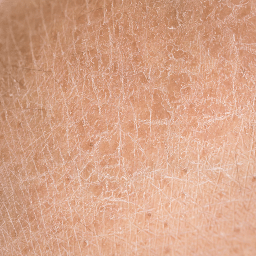 XEROTIC DERMATITIS