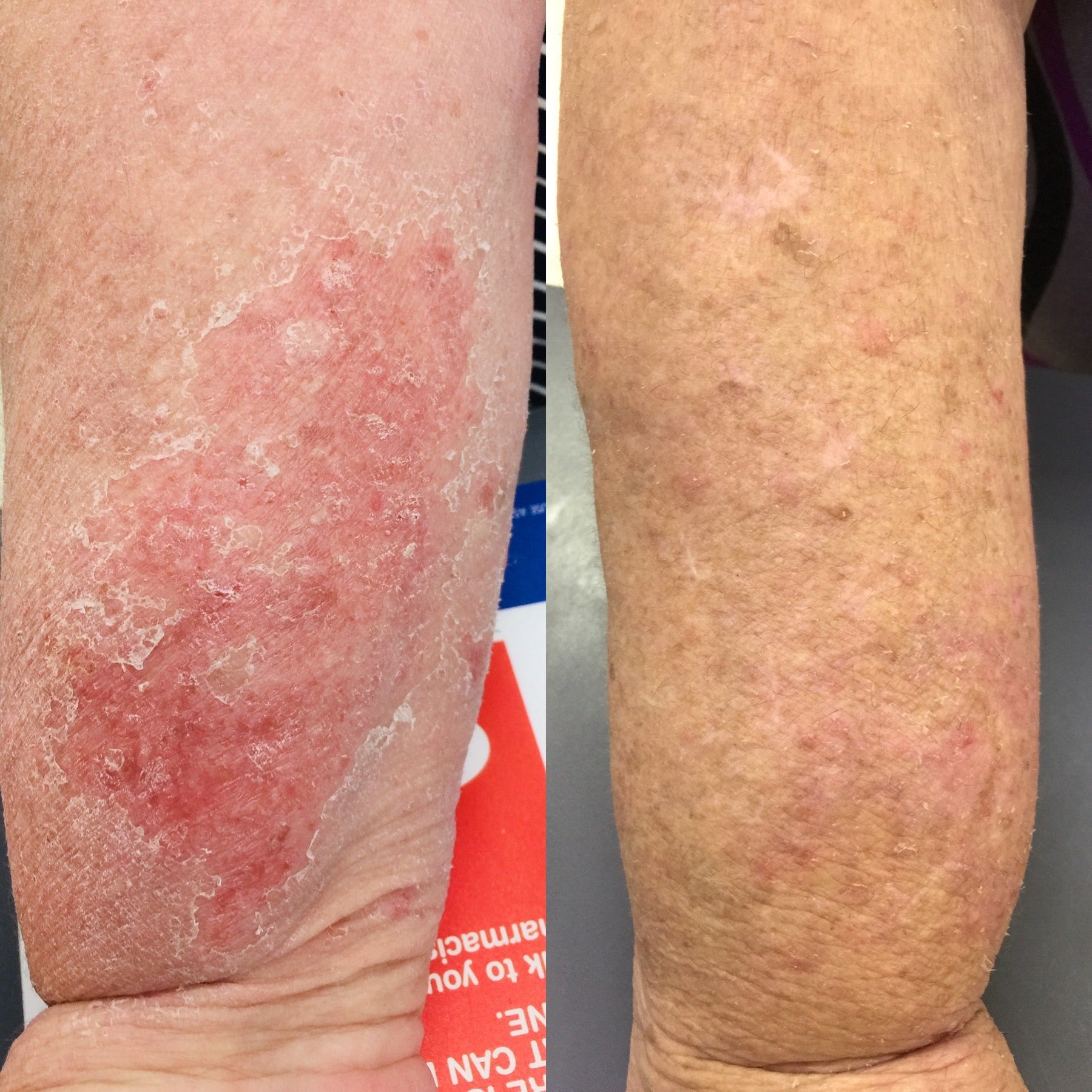 Steoid Rash Topical Steroid Withdrawal: What you need to know – DermaGen by ...